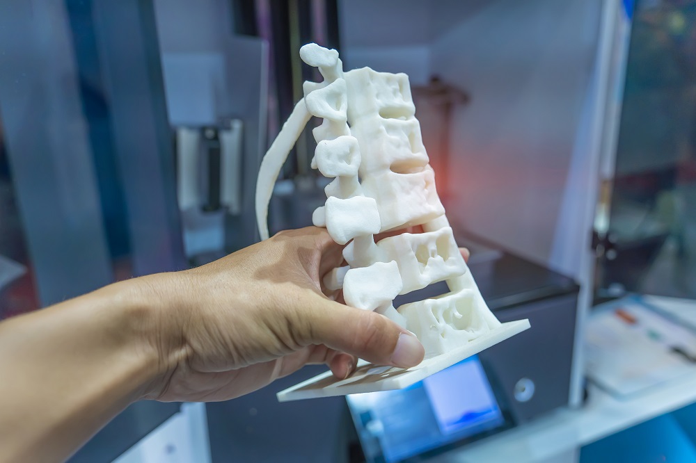 What Makes 3D-Printed Implants a Smart Choice for Complex Spines