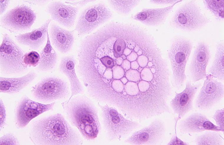 Topic 8: Living Better with Diabetes: Anita’s Stem Cell Therapy Experience in India